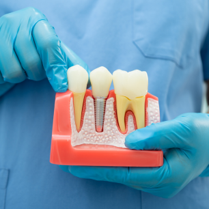 Implantes Nuevos